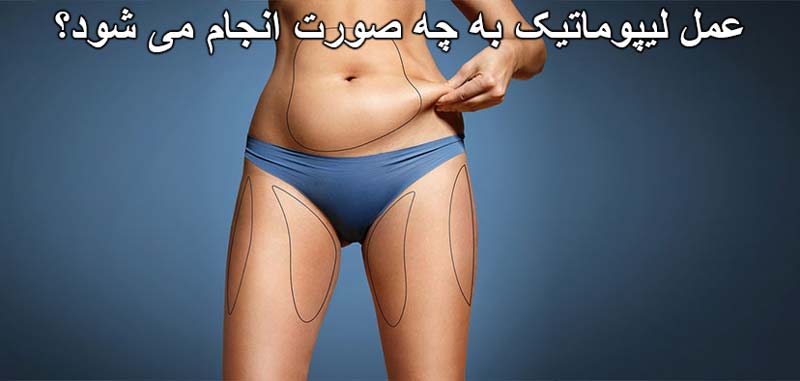 عمل لیپوماتیک به چه صورت انجام می شود؟