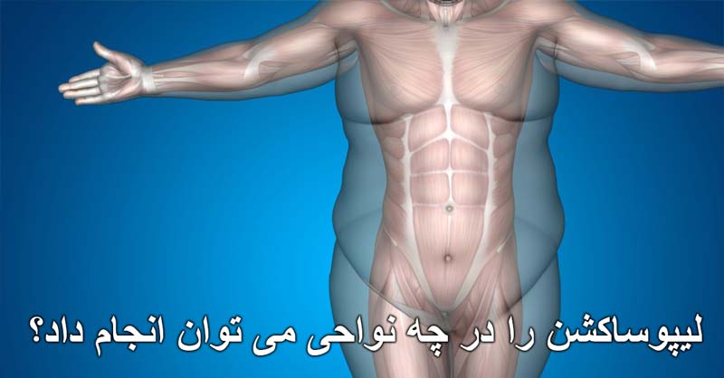 لیپوساکشن را در چه نواحی می توان انجام داد؟