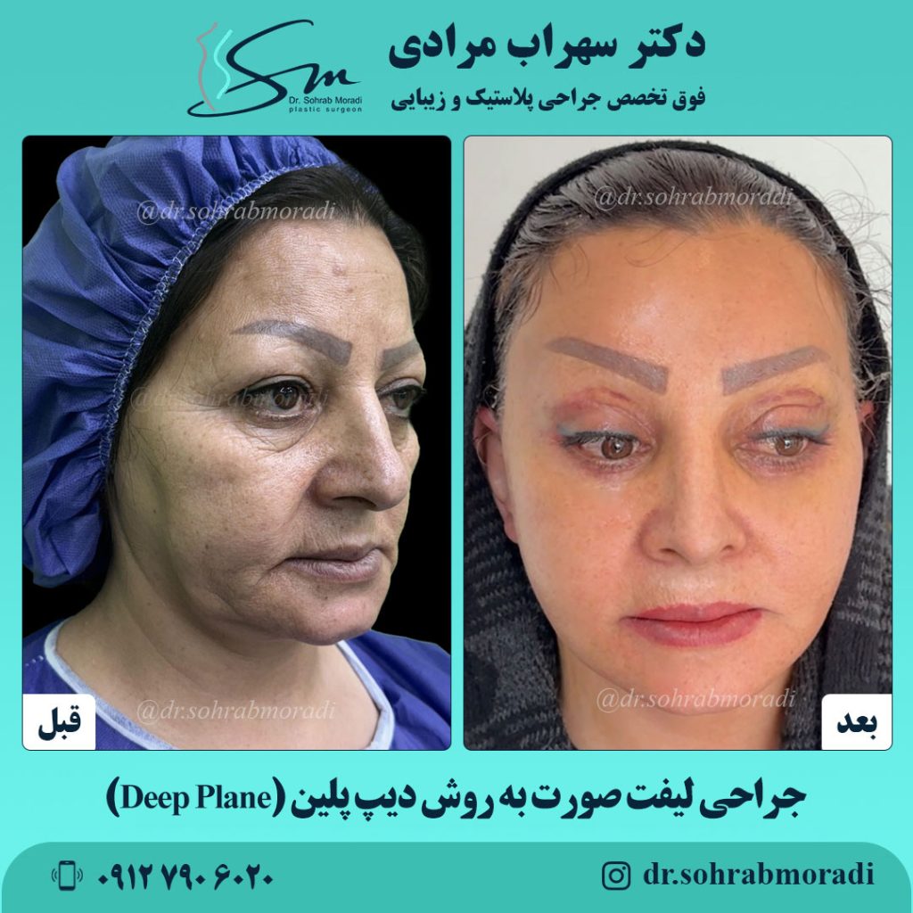 نمونه کار جراحی لیفت صورت به روش دیپ پلین